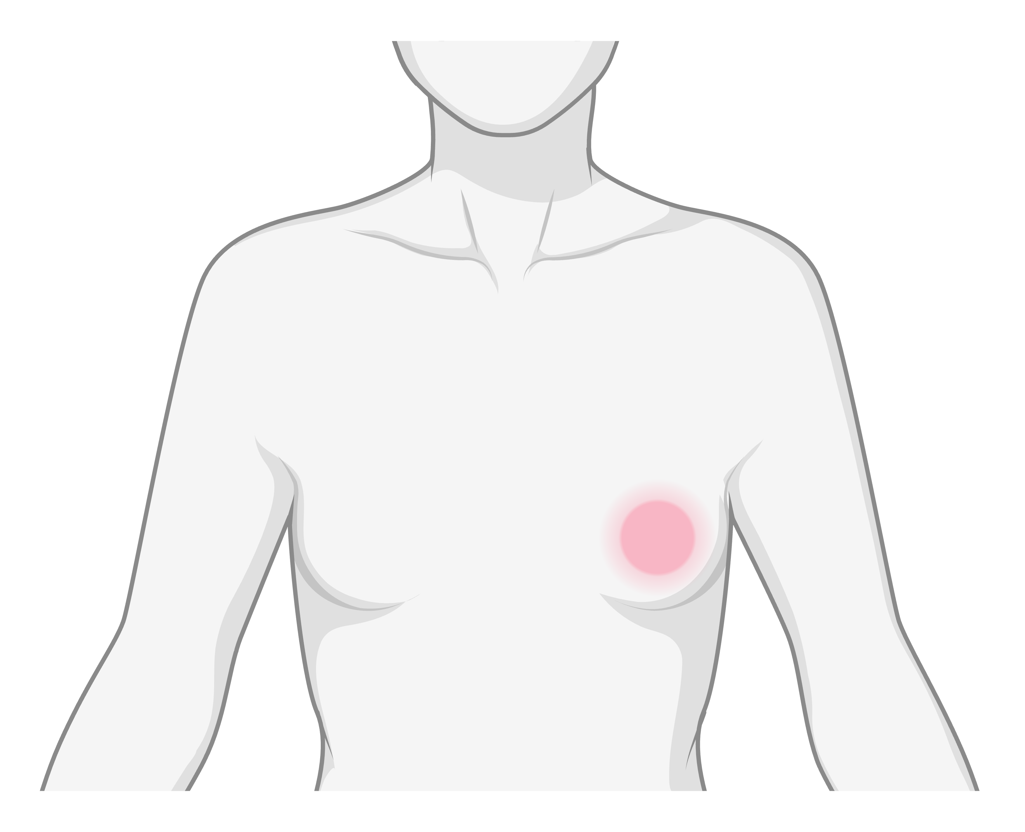 Breast cancer tissue illustration or overview graphic.
