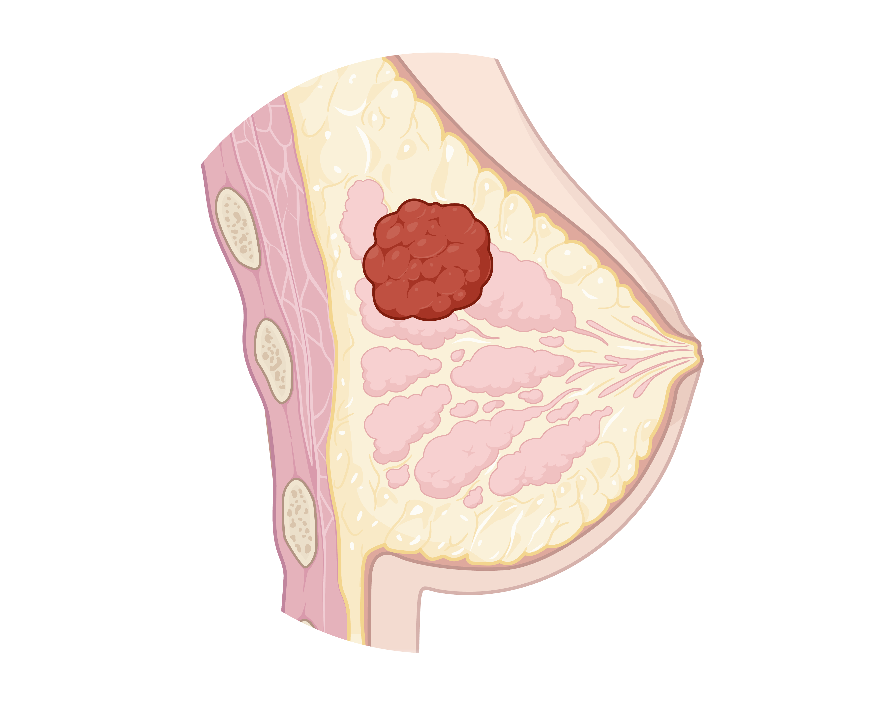 Breast cancer tissue cohort and spatial analysis visualization.