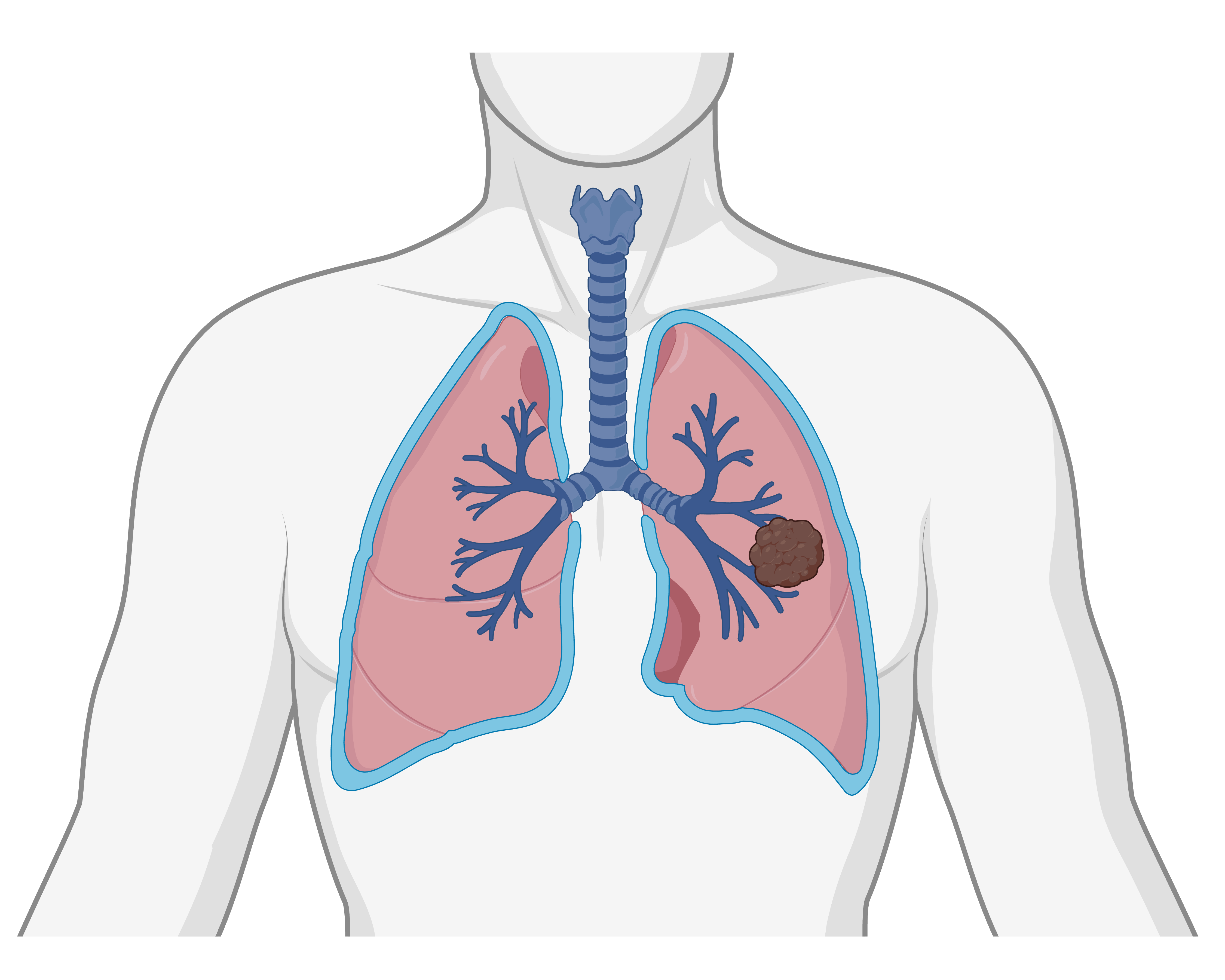 Lung cancer tissue illustration or overview graphic.